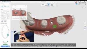 Implant Case Scan Using Medit i700W & Model