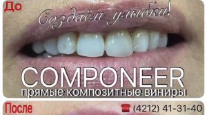 Компониры - прямые композитные виниры. Учебный центр "IQSTOM".