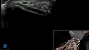 3D-пособие: Катетеризация лучевой артерии под контролем ультразвука (с поперечным доступом)