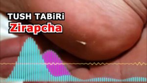 Zirapcha tikan kirishining tush talqini - tushda Zirapcha - Зирапча (тикан) киришининг туш талқини
