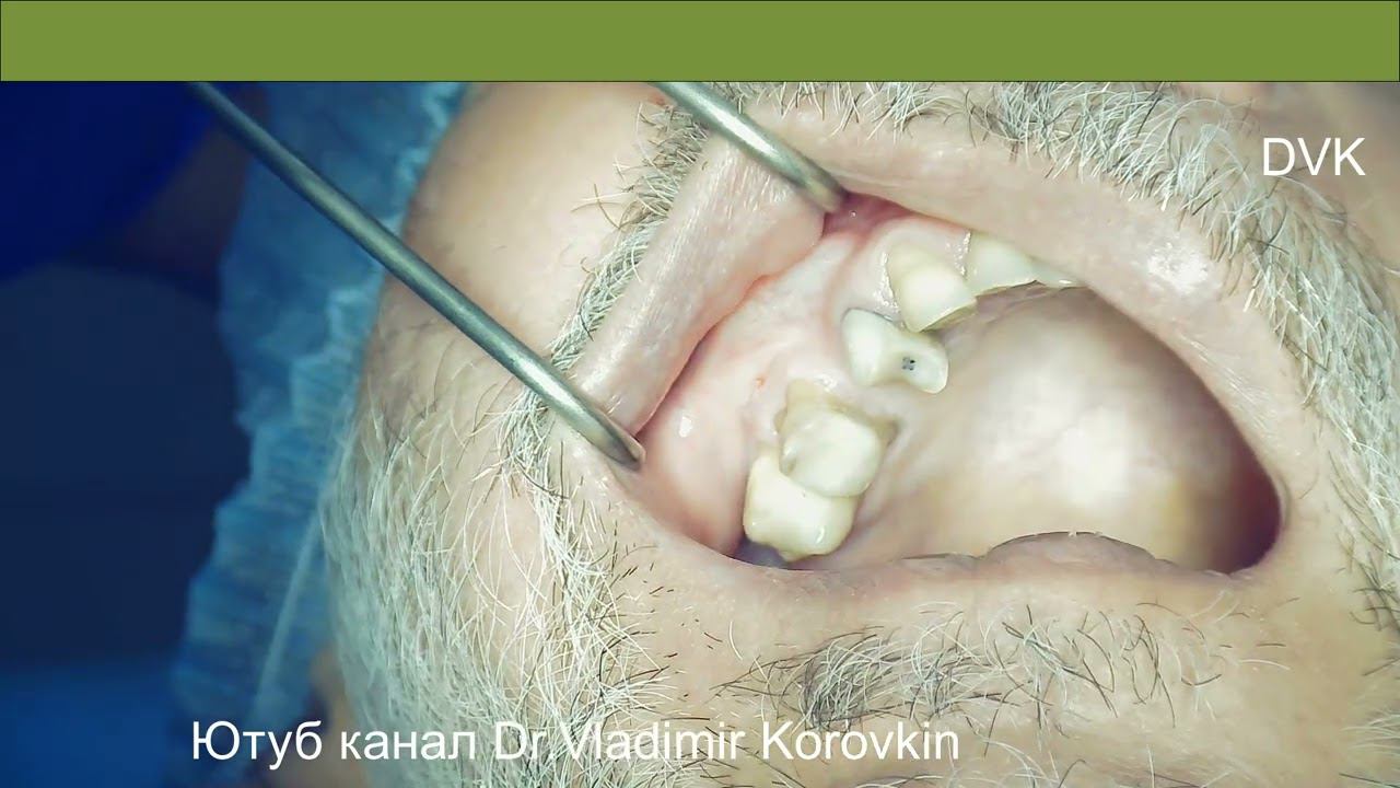 Инфильтрационная анестезия для имплантации 15.#localanesthesia #infiltration #anaesthesia
