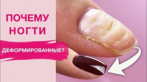 ДЕФОРМИРОВАННЫЕ ногти? Исправляем и делаем укрепление полигелем