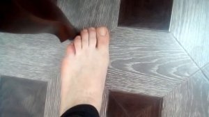 Перелом мизинца. Как выглядит палец после перелома.