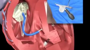 Кардиостимуляторы и электроды