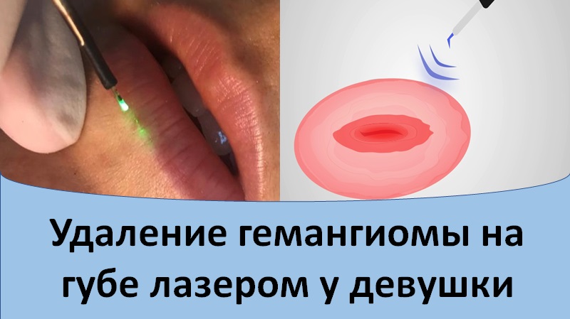 Удаление гемангиомы на губе лазером у девушки.