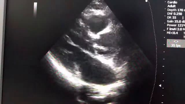 Двустворчатый клапан, парастернальный доступ по длинной оси смотреть онлайн