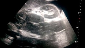 забрюшинные лимфоузлы при лимфоме