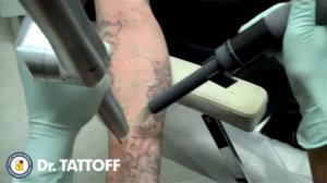 Сведение татуировки с помощью лазера