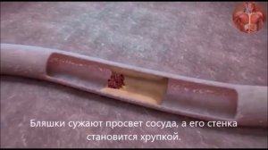 Что происходит при инфаркте?