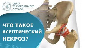 Что такое асептический некроз головки бедренной кости? Асептический некроз головки бедра. 18+