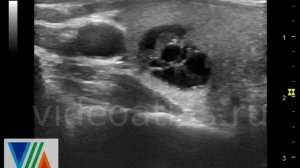 Почти полностью кистозное образование ЩЖ