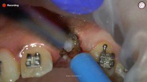 Процедура обнажения ретенированного клыка