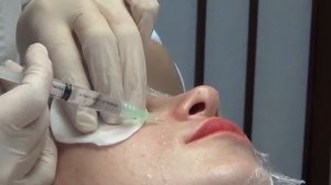 Биоревитализация  Активный лифтинг  в Клинике Эдит