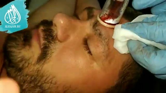 Обучение хиджаме в Красноярске