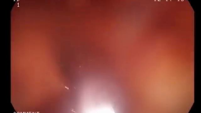 Эндоскопическая полипэктомия смотреть онлайн