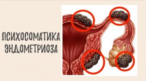 Психосоматика эндометриоза - эндометриоз и его настоящие причины.