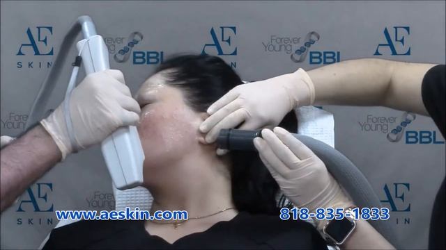 Forever Young BBL IPL Photofacial Demonstration 43 - A E Skin - Encino, CA - 818-835-1833 смотреть онлайн