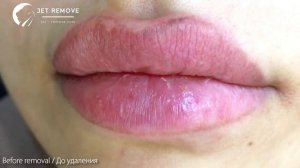 Удаление татуажа губ ремувером Jet Remove.
