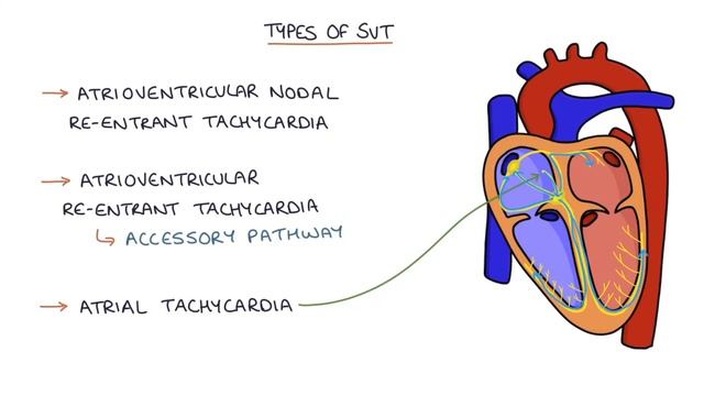 Understanding Supraventricular Tachycardia SVT