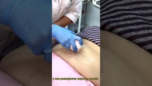RF-лифтинг EndyMed PRO