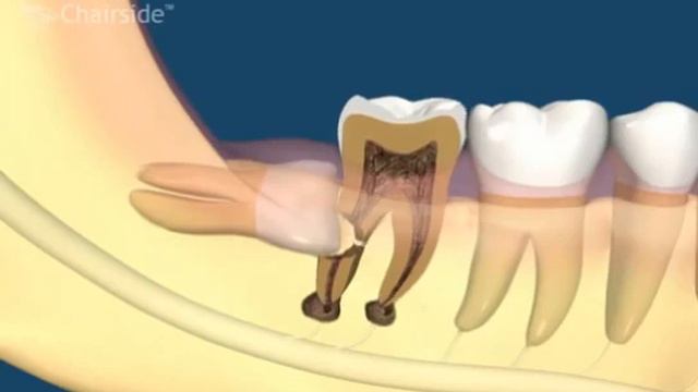 Осложнения зубов мудрости смотреть онлайн