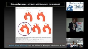 Острый аортальный синдром - тип A по Stanford МДКТ восходящей аорты. Лучевая диагностика