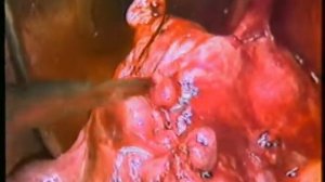 1995. Baltasar. VARY (Billroth-III). Vagotomy + Antrectomy and RNY reconstruction for duodenal ulce