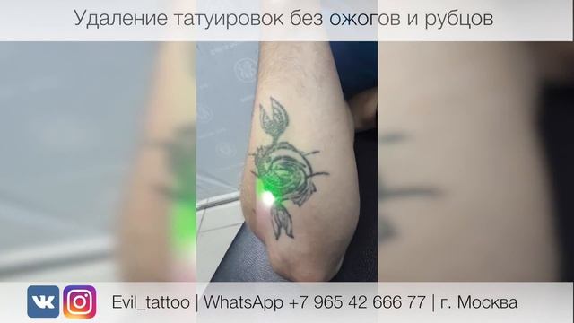 Лазерное удаление татуировки в студии Evil Tattoo. Без травм, ожогов и рубцов.