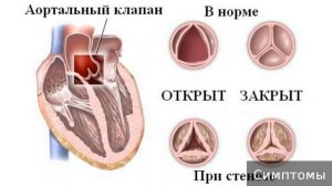 Митральный стеноз. Как лечить митральный стеноз.