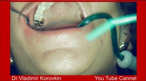 Снятие штампованной коронки 17.  Подготовка к лечению.