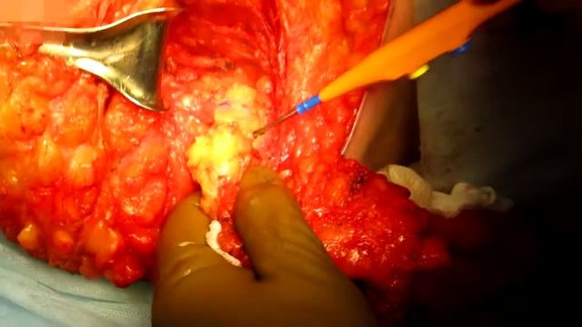 ALND (axillary lymph node dissection) смотреть онлайн