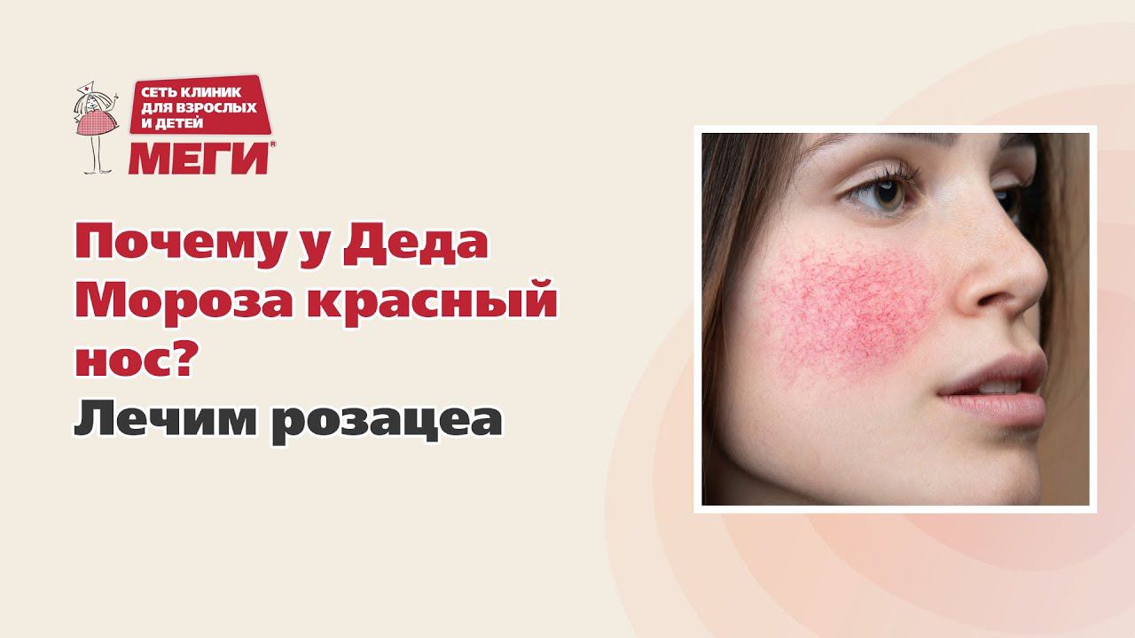 Почему у Деда Мороза красный нос? Лечим розацеа