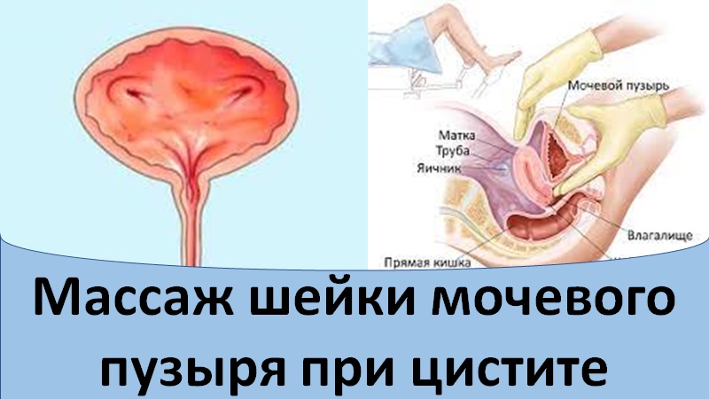 Массаж шейки мочевого пузыря при цистите