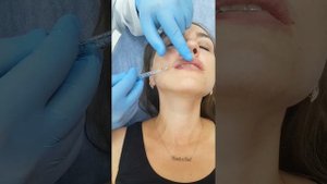 Увеличение губ филлером с помощью атравматической канюли. Подробно всё рассказываю и показываю.