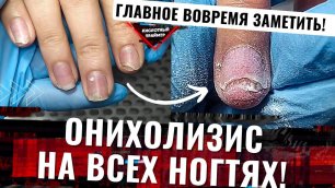 😱Жесткий Онихолизис Ногтей на руках ВСЕХ пальцев! Ожог ногтевой пластины,боковой онихолизис. Часть