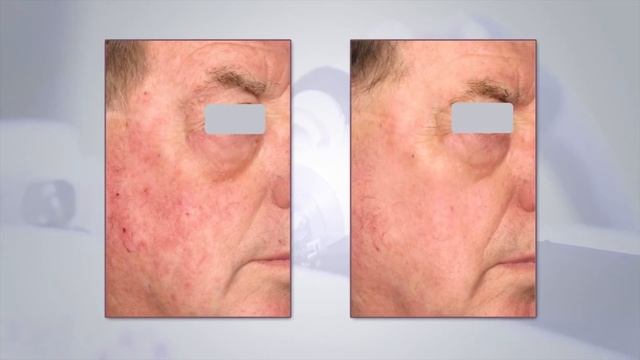 Fraxel re:store Dual- фракционный лазер номер 1 в мире смотреть онлайн