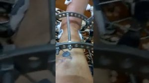 Выбор веры! Перелом ноги . Таранная кость