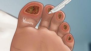 ASMR Treatment Athlete's Foot And Warts Between Toes | 무좀과 발가락 사이의 사마귀 치료 | Foot Care Animation