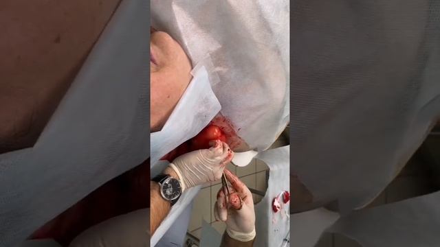 Липома смотреть онлайн