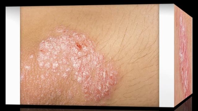 Prednisolone 5 mg,10 mg,20 mg tablet / uses and side effects in hindi/urdu смотреть онлайн