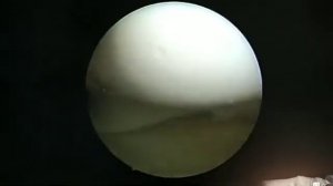 Артроскопия Пластика ПКС аутографтом ST&GRSmith&Nephew Ultrabutton, Screw Conmed, Шов мениска