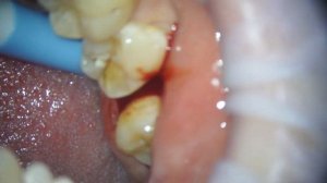 Удаление восьмого зуба , зуба мудрости#стоматология #пломба #имплант #стоматолог #кариес #виниры