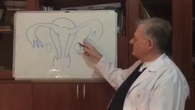 меж фимбриальные спайки маточной трубы. фимбриолизис. фертилоскопия смотреть онлайн