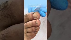 Инструкция, как избавиться от вросшего ногтя