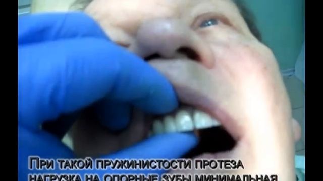 Принципиально новый бюгельный протез. Ч.2
