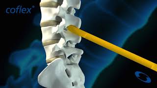 Coflex - межостистый фиксатор. Устанавливается для разгрузки смежных сегментов пдс. смотреть онлайн