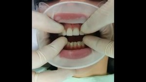 Установка прямых виниров на зубы