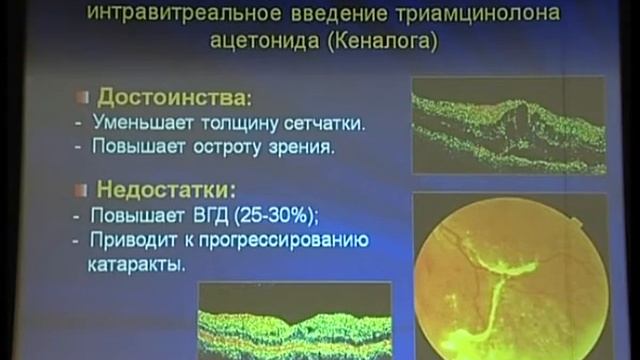 Современные аспекты лечения диабетической ретинопатии и диабетического макулярного отёка