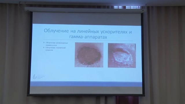 Николаева Е.Н. — Возможности дистанционной лучевой терапии в лечении опухолей кожи смотреть онлайн