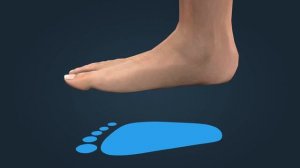 Плоскостопие | Анатомия человека | Биология